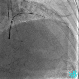明胶在血管怎么降解并发症丨前降支CTO同侧逆向开通时侧支血管破裂，弹簧圈联合明胶海绵封堵_https://www.jmylbn.com_新闻资讯_第12张