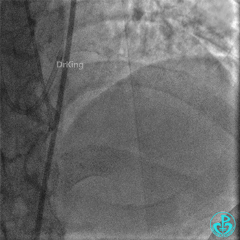 明胶在血管怎么降解并发症丨前降支CTO同侧逆向开通时侧支血管破裂，弹簧圈联合明胶海绵封堵_https://www.jmylbn.com_新闻资讯_第7张