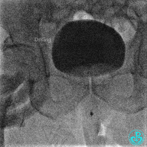 明胶在血管怎么降解并发症丨前降支CTO同侧逆向开通时侧支血管破裂，弹簧圈联合明胶海绵封堵_https://www.jmylbn.com_新闻资讯_第38张