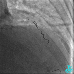 明胶在血管怎么降解并发症丨前降支CTO同侧逆向开通时侧支血管破裂，弹簧圈联合明胶海绵封堵_https://www.jmylbn.com_新闻资讯_第35张