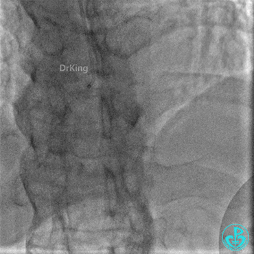 明胶在血管怎么降解并发症丨前降支CTO同侧逆向开通时侧支血管破裂，弹簧圈联合明胶海绵封堵_https://www.jmylbn.com_新闻资讯_第5张