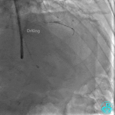明胶在血管怎么降解并发症丨前降支CTO同侧逆向开通时侧支血管破裂，弹簧圈联合明胶海绵封堵_https://www.jmylbn.com_新闻资讯_第15张
