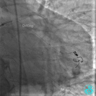 明胶在血管怎么降解并发症丨前降支CTO同侧逆向开通时侧支血管破裂，弹簧圈联合明胶海绵封堵_https://www.jmylbn.com_新闻资讯_第52张