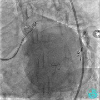 明胶在血管怎么降解并发症丨前降支CTO同侧逆向开通时侧支血管破裂，弹簧圈联合明胶海绵封堵_https://www.jmylbn.com_新闻资讯_第36张