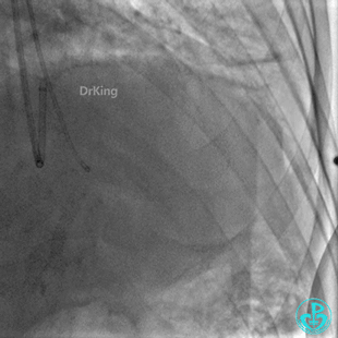 明胶在血管怎么降解并发症丨前降支CTO同侧逆向开通时侧支血管破裂，弹簧圈联合明胶海绵封堵_https://www.jmylbn.com_新闻资讯_第8张