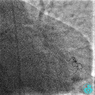 明胶在血管怎么降解并发症丨前降支CTO同侧逆向开通时侧支血管破裂，弹簧圈联合明胶海绵封堵_https://www.jmylbn.com_新闻资讯_第51张
