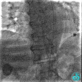 明胶在血管怎么降解并发症丨前降支CTO同侧逆向开通时侧支血管破裂，弹簧圈联合明胶海绵封堵_https://www.jmylbn.com_新闻资讯_第50张