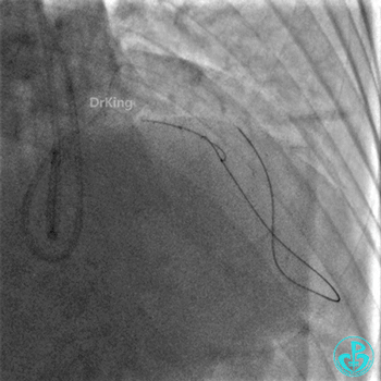 明胶在血管怎么降解并发症丨前降支CTO同侧逆向开通时侧支血管破裂，弹簧圈联合明胶海绵封堵_https://www.jmylbn.com_新闻资讯_第24张
