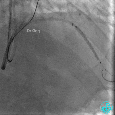 明胶在血管怎么降解并发症丨前降支CTO同侧逆向开通时侧支血管破裂，弹簧圈联合明胶海绵封堵_https://www.jmylbn.com_新闻资讯_第29张