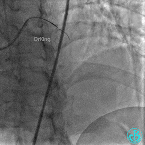 明胶在血管怎么降解并发症丨前降支CTO同侧逆向开通时侧支血管破裂，弹簧圈联合明胶海绵封堵_https://www.jmylbn.com_新闻资讯_第11张