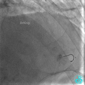 明胶在血管怎么降解并发症丨前降支CTO同侧逆向开通时侧支血管破裂，弹簧圈联合明胶海绵封堵_https://www.jmylbn.com_新闻资讯_第33张