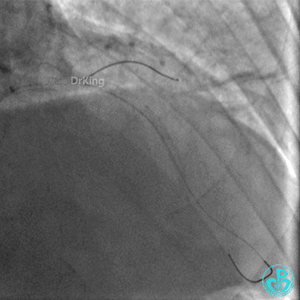 明胶在血管怎么降解并发症丨前降支CTO同侧逆向开通时侧支血管破裂，弹簧圈联合明胶海绵封堵_https://www.jmylbn.com_新闻资讯_第31张