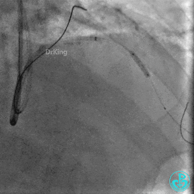 明胶在血管怎么降解并发症丨前降支CTO同侧逆向开通时侧支血管破裂，弹簧圈联合明胶海绵封堵_https://www.jmylbn.com_新闻资讯_第28张