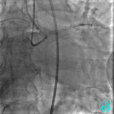 明胶在血管怎么降解并发症丨前降支CTO同侧逆向开通时侧支血管破裂，弹簧圈联合明胶海绵封堵_https://www.jmylbn.com_新闻资讯_第16张