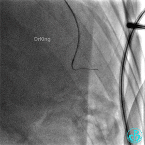 明胶在血管怎么降解并发症丨前降支CTO同侧逆向开通时侧支血管破裂，弹簧圈联合明胶海绵封堵_https://www.jmylbn.com_新闻资讯_第22张