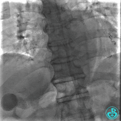 明胶在血管怎么降解并发症丨前降支CTO同侧逆向开通时侧支血管破裂，弹簧圈联合明胶海绵封堵_https://www.jmylbn.com_新闻资讯_第45张