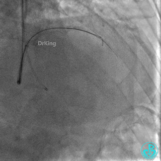 明胶在血管怎么降解并发症丨前降支CTO同侧逆向开通时侧支血管破裂，弹簧圈联合明胶海绵封堵_https://www.jmylbn.com_新闻资讯_第14张