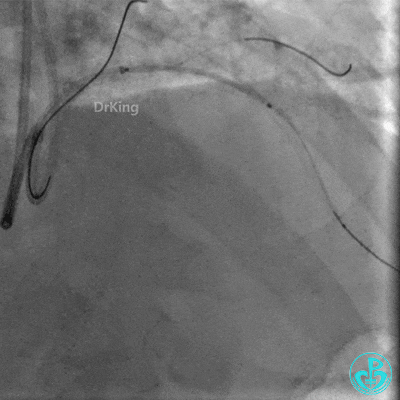 明胶在血管怎么降解并发症丨前降支CTO同侧逆向开通时侧支血管破裂，弹簧圈联合明胶海绵封堵_https://www.jmylbn.com_新闻资讯_第30张