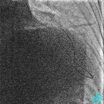 明胶在血管怎么降解并发症丨前降支CTO同侧逆向开通时侧支血管破裂，弹簧圈联合明胶海绵封堵_https://www.jmylbn.com_新闻资讯_第23张