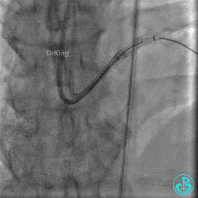 明胶在血管怎么降解并发症丨前降支CTO同侧逆向开通时侧支血管破裂，弹簧圈联合明胶海绵封堵_https://www.jmylbn.com_新闻资讯_第27张
