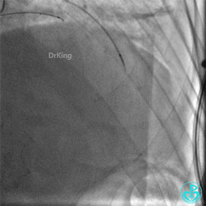 明胶在血管怎么降解并发症丨前降支CTO同侧逆向开通时侧支血管破裂，弹簧圈联合明胶海绵封堵_https://www.jmylbn.com_新闻资讯_第18张