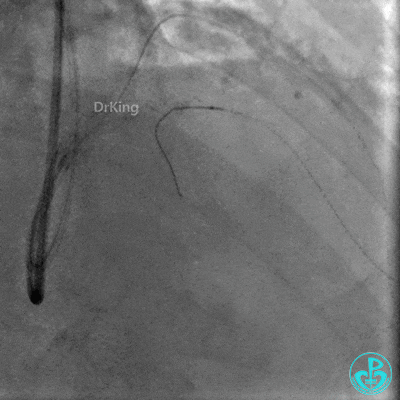明胶在血管怎么降解并发症丨前降支CTO同侧逆向开通时侧支血管破裂，弹簧圈联合明胶海绵封堵_https://www.jmylbn.com_新闻资讯_第26张