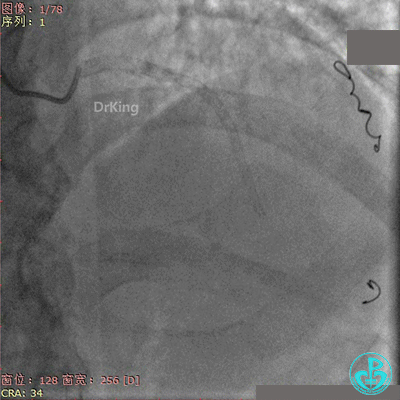 明胶在血管怎么降解并发症丨前降支CTO同侧逆向开通时侧支血管破裂，弹簧圈联合明胶海绵封堵_https://www.jmylbn.com_新闻资讯_第57张