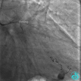 明胶在血管怎么降解并发症丨前降支CTO同侧逆向开通时侧支血管破裂，弹簧圈联合明胶海绵封堵_https://www.jmylbn.com_新闻资讯_第54张