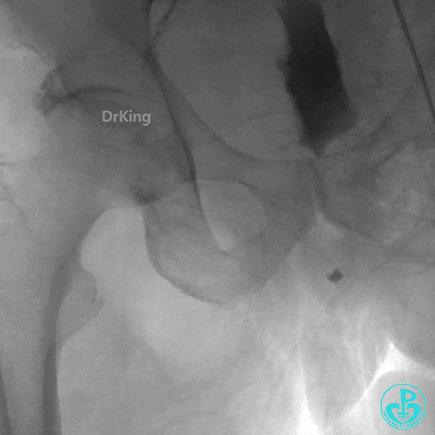 明胶在血管怎么降解并发症丨前降支CTO同侧逆向开通时侧支血管破裂，弹簧圈联合明胶海绵封堵_https://www.jmylbn.com_新闻资讯_第44张
