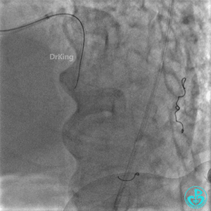 明胶在血管怎么降解并发症丨前降支CTO同侧逆向开通时侧支血管破裂，弹簧圈联合明胶海绵封堵_https://www.jmylbn.com_新闻资讯_第37张