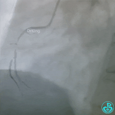 泥鳅导丝怎么用泥鳅导丝致主动脉窦底夹层造影剂滞留_https://www.jmylbn.com_新闻资讯_第1张