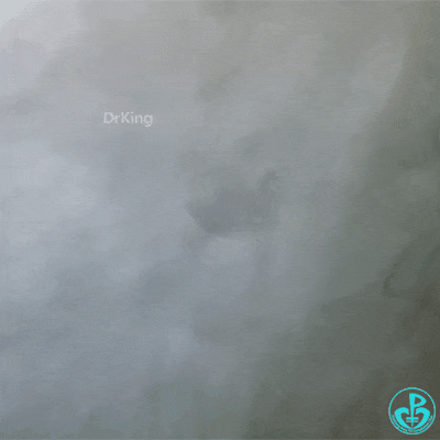 泥鳅导丝怎么用泥鳅导丝致主动脉窦底夹层造影剂滞留_https://www.jmylbn.com_新闻资讯_第8张