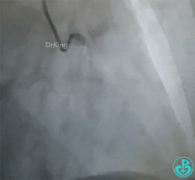 泥鳅导丝怎么用泥鳅导丝致主动脉窦底夹层造影剂滞留_https://www.jmylbn.com_新闻资讯_第2张