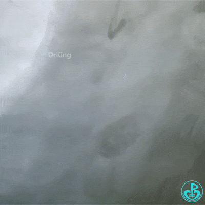 泥鳅导丝怎么用泥鳅导丝致主动脉窦底夹层造影剂滞留_https://www.jmylbn.com_新闻资讯_第3张