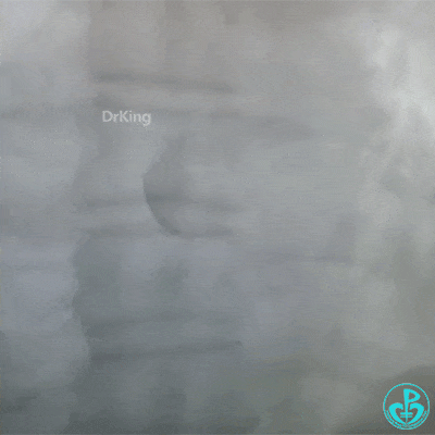 泥鳅导丝怎么用泥鳅导丝致主动脉窦底夹层造影剂滞留_https://www.jmylbn.com_新闻资讯_第6张