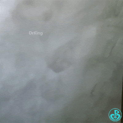 泥鳅导丝怎么用泥鳅导丝致主动脉窦底夹层造影剂滞留_https://www.jmylbn.com_新闻资讯_第5张