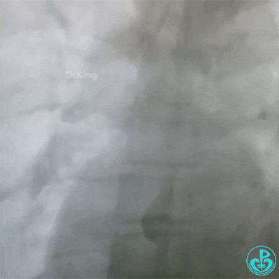 泥鳅导丝怎么用泥鳅导丝致主动脉窦底夹层造影剂滞留_https://www.jmylbn.com_新闻资讯_第4张