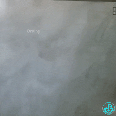 泥鳅导丝怎么用泥鳅导丝致主动脉窦底夹层造影剂滞留_https://www.jmylbn.com_新闻资讯_第7张