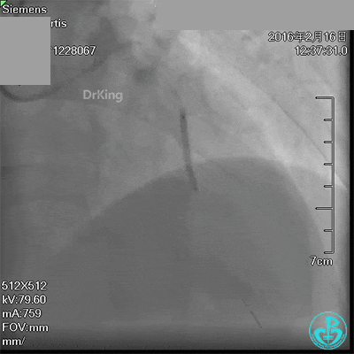 泥鳅导丝怎么用超滑泥鳅导丝致纵隔血肿，保守治疗血肿吸收_https://www.jmylbn.com_新闻资讯_第9张
