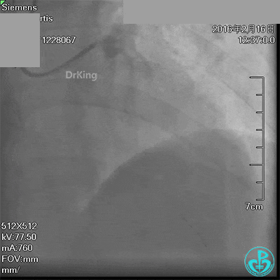 泥鳅导丝怎么用超滑泥鳅导丝致纵隔血肿，保守治疗血肿吸收_https://www.jmylbn.com_新闻资讯_第8张