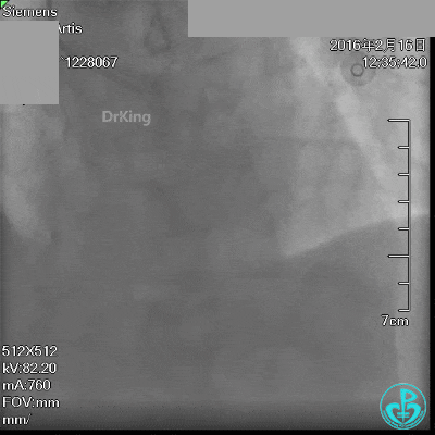 泥鳅导丝怎么用超滑泥鳅导丝致纵隔血肿，保守治疗血肿吸收_https://www.jmylbn.com_新闻资讯_第2张