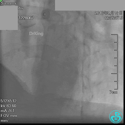 泥鳅导丝怎么用超滑泥鳅导丝致纵隔血肿，保守治疗血肿吸收_https://www.jmylbn.com_新闻资讯_第3张