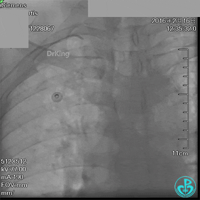 泥鳅导丝怎么用超滑泥鳅导丝致纵隔血肿，保守治疗血肿吸收_https://www.jmylbn.com_新闻资讯_第17张