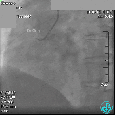 泥鳅导丝怎么用超滑泥鳅导丝致纵隔血肿，保守治疗血肿吸收_https://www.jmylbn.com_新闻资讯_第5张