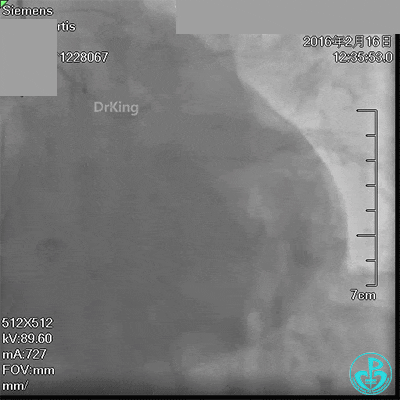 泥鳅导丝怎么用超滑泥鳅导丝致纵隔血肿，保守治疗血肿吸收_https://www.jmylbn.com_新闻资讯_第4张