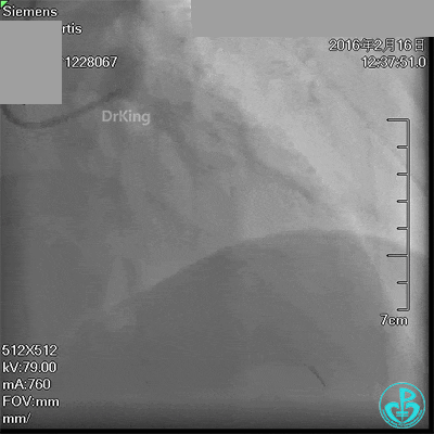 泥鳅导丝怎么用超滑泥鳅导丝致纵隔血肿，保守治疗血肿吸收_https://www.jmylbn.com_新闻资讯_第10张