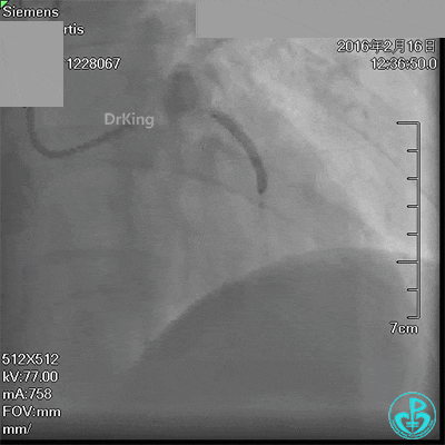 泥鳅导丝怎么用超滑泥鳅导丝致纵隔血肿，保守治疗血肿吸收_https://www.jmylbn.com_新闻资讯_第7张