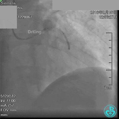 泥鳅导丝怎么用超滑泥鳅导丝致纵隔血肿，保守治疗血肿吸收_https://www.jmylbn.com_新闻资讯_第6张
