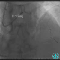 为什么要用到微导管KDLC双腔微导管在反转导丝中的应用_https://www.jmylbn.com_新闻资讯_第11张