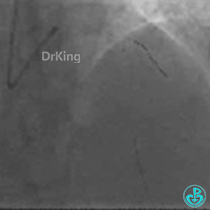 为什么要用到微导管KDLC双腔微导管在反转导丝中的应用_https://www.jmylbn.com_新闻资讯_第7张